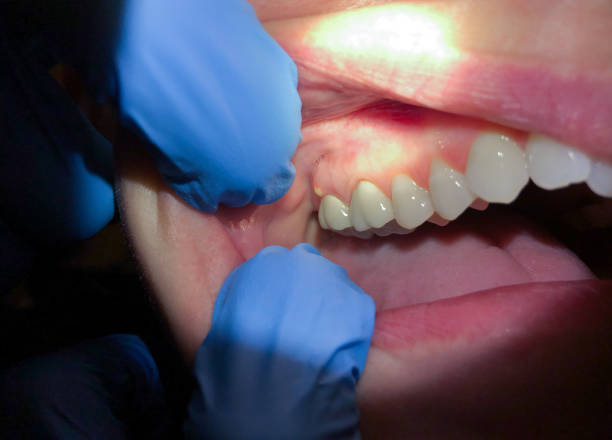 Best Emergency Root Canal Treatment in Boonville, IN