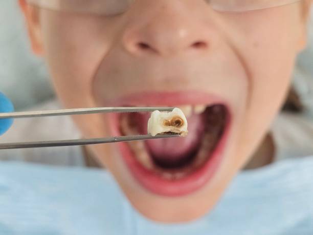 Best Emergency Dentist for Knocked-Out Tooth in Boonville, IN