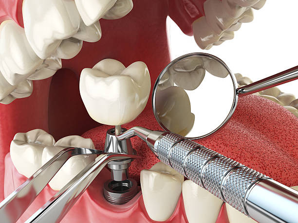 Best Emergency Dentist for Lost Fillings or Crowns in Boonville, IN